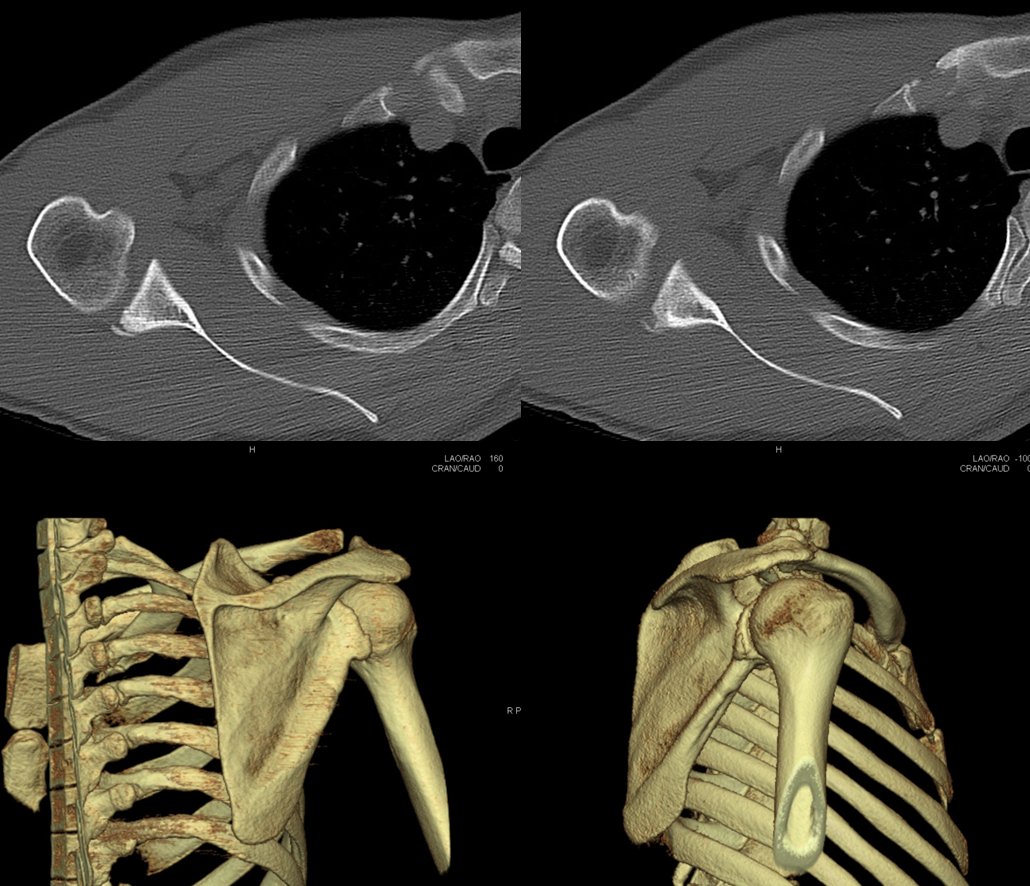 Figure 4 for case Bennett lesion